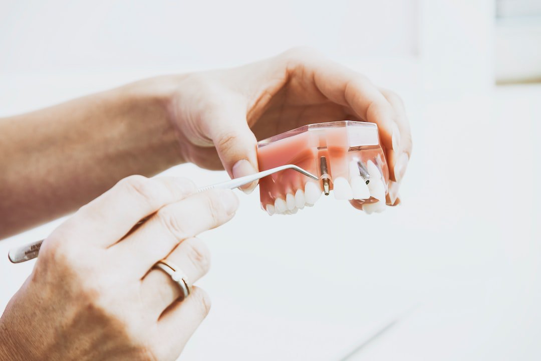 Implanty zębowe: Zalety implantologii stomatologicznej i jakie są możliwości odbudowy utraconych zębów?