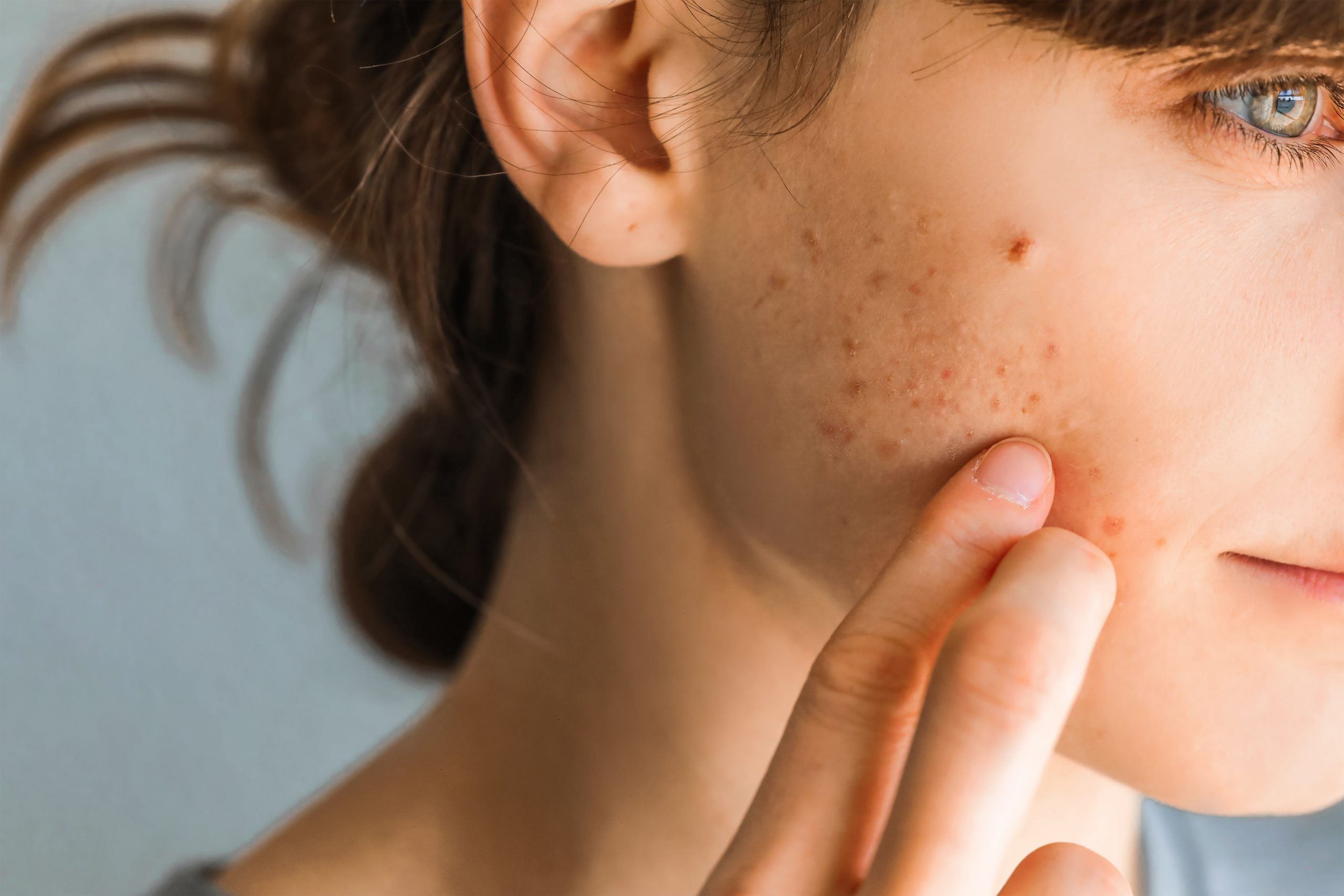 Pielęgnacja skóry trądzikowej – najważniejsze zasady